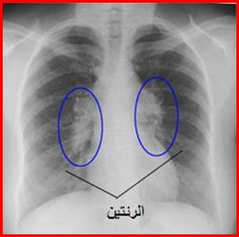     Chest X-ray