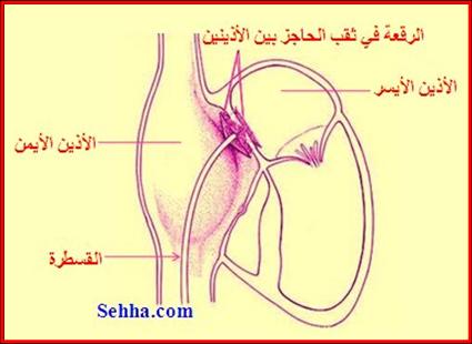   cardiac catheterization