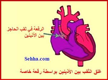    Open-heart surgery