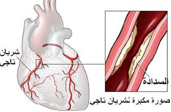    ::    Myocardial infarction