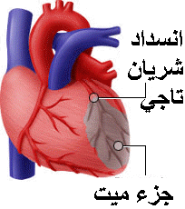    ::    Myocardial infarction