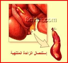     Appendectomy