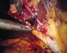    ()  Laparascopic Cholysistectomy