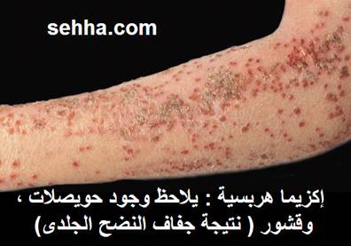 إكزيما هربسية: يلاحظ وجود حويصلات و قشور نتيجة جفاف النضج الجلدي