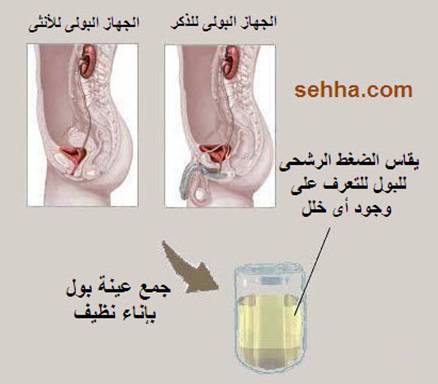 الضغط الرشحي للبول urine osmolality