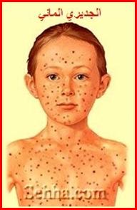 الجديري المائي - العنقز Chickenpox - Varicella