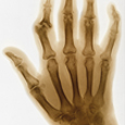 الالتهاب الروماتويدي المفصلي Rheumatoid arthritis