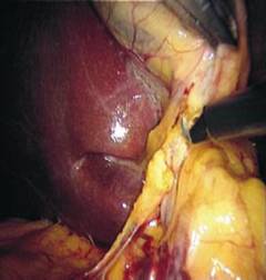 استئصال الحويصلة الصفراوية (المرارة) بالمنظار Laparascopic Cholysistectomy