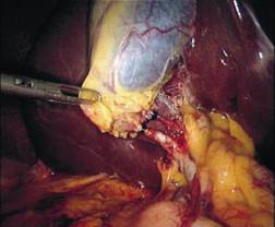 استئصال الحويصلة الصفراوية (المرارة) بالمنظار Laparascopic Cholysistectomy