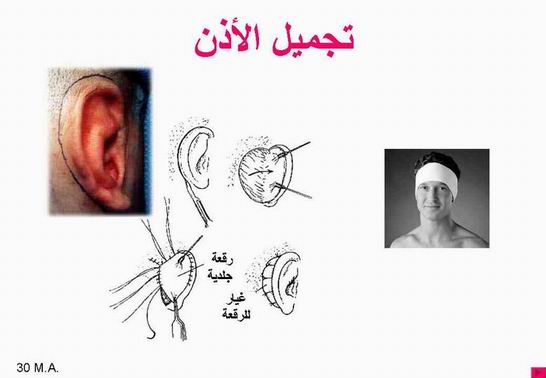 كل ما تريد معرفته عن جراحة تجميل الأذن Otoplasty