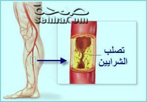 تصلب الشرايين