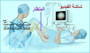 منظار المثانة 