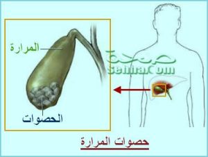 حصوات المرارة