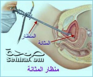 منظار المثانة