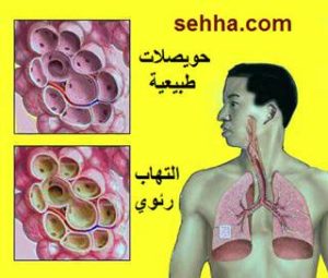 التهاب رئوي