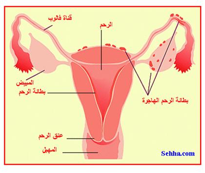ما هو داء بطانة الرحم الهاجرة؟ What is endometriosis